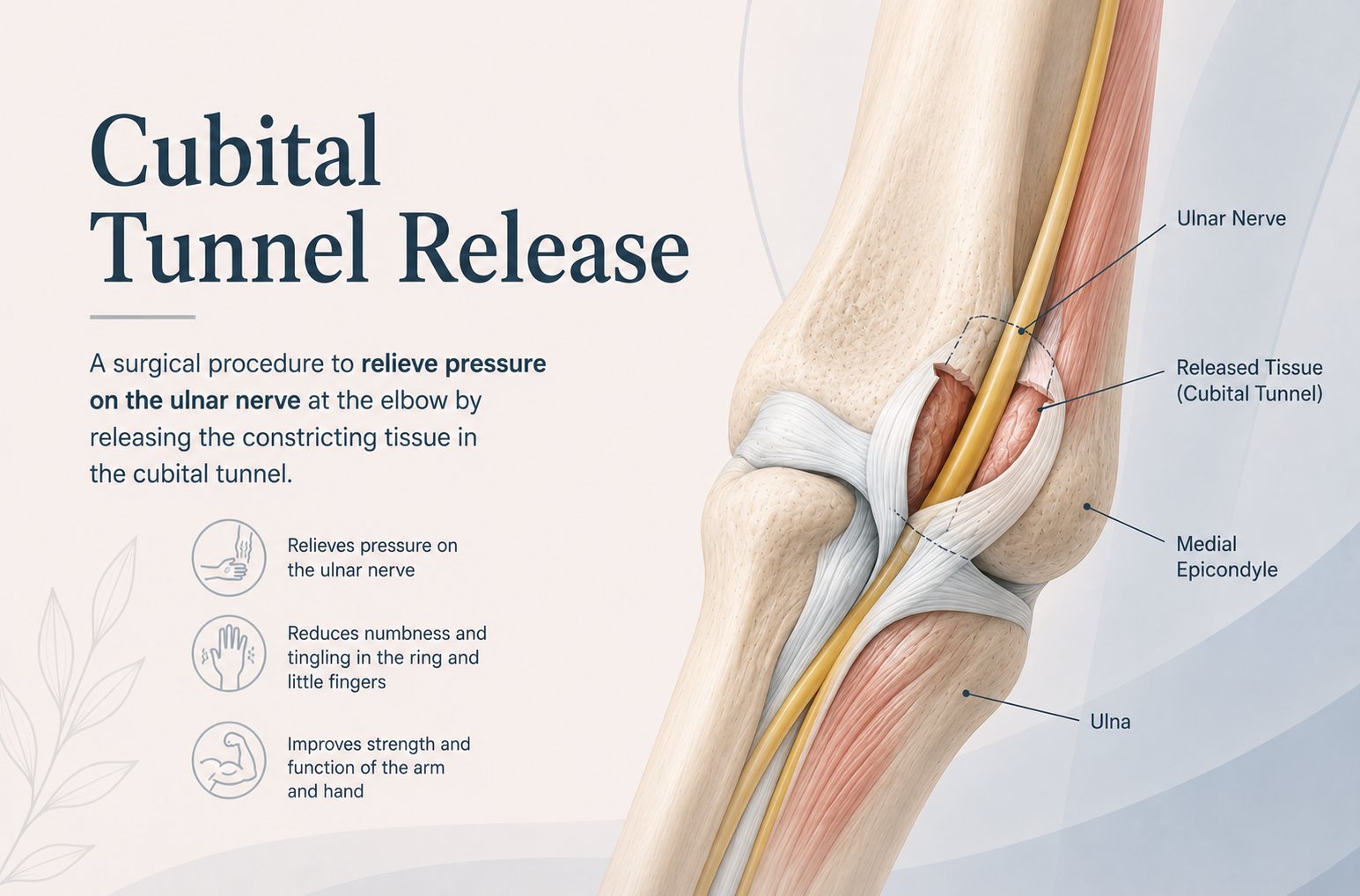 Cubital Tunnel Release