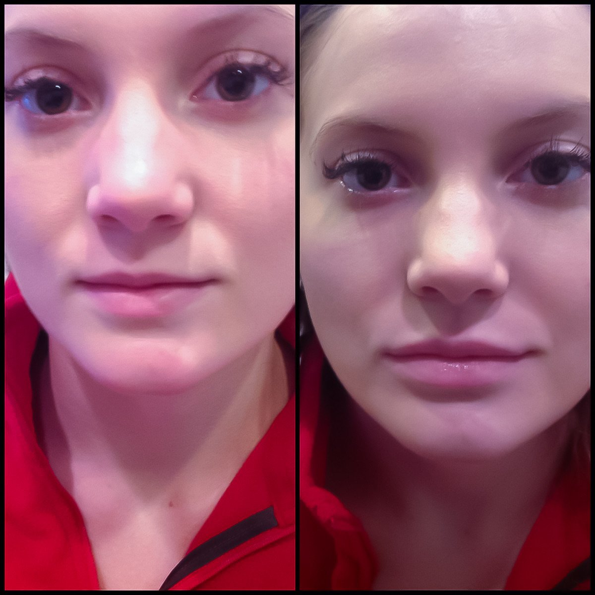 Lip enhancement with filler