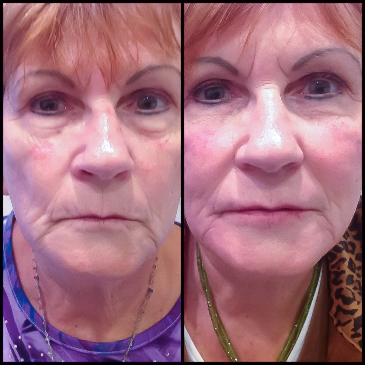 Dermal filler for cheek /facial volume restoration