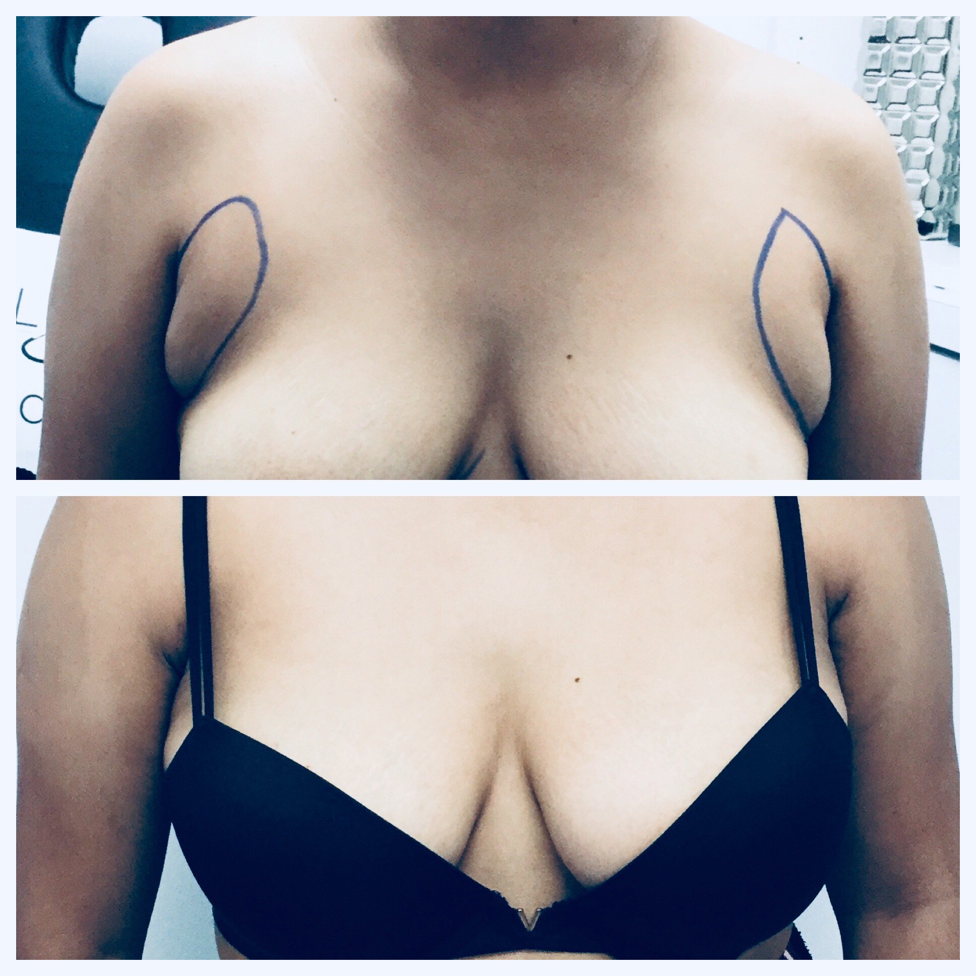 Kybella fat dissolve for bra fat deposits