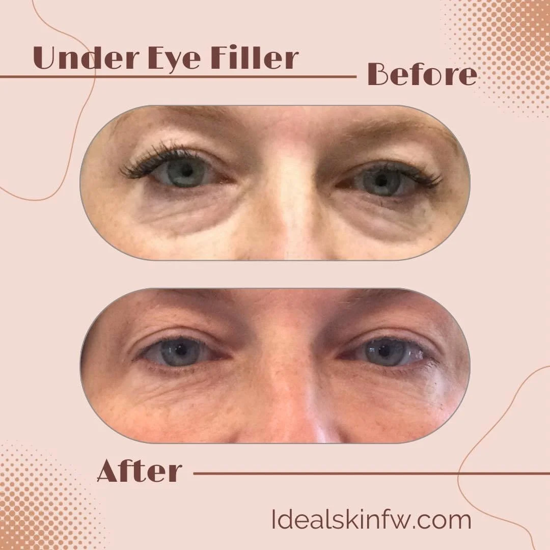 Dermal filler for undereye volume restoration