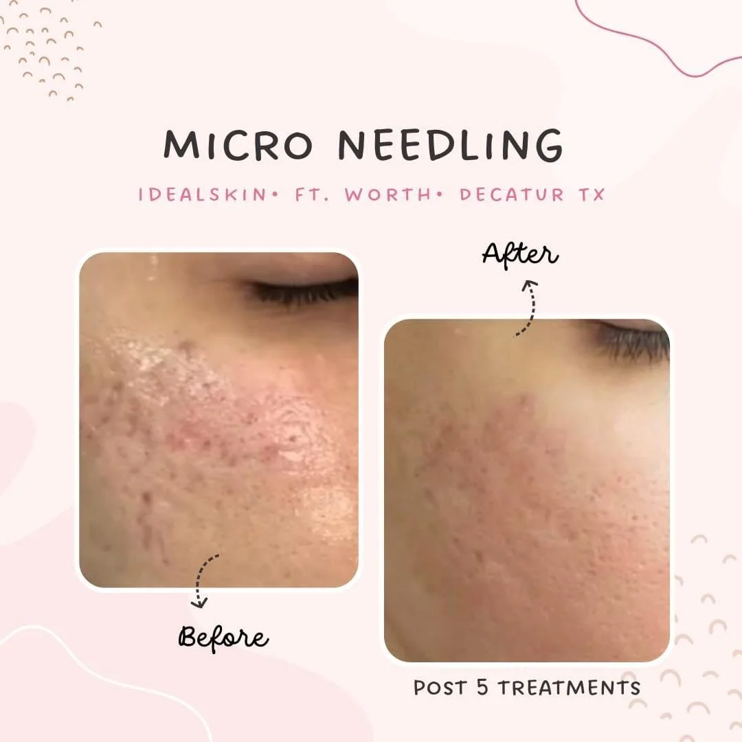 Microneeding texture repair