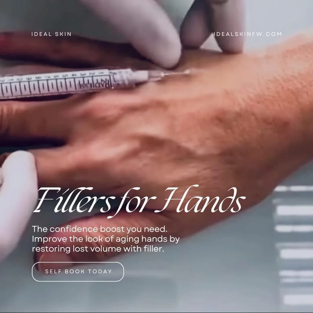 Dermal filler for hand rejuvenation