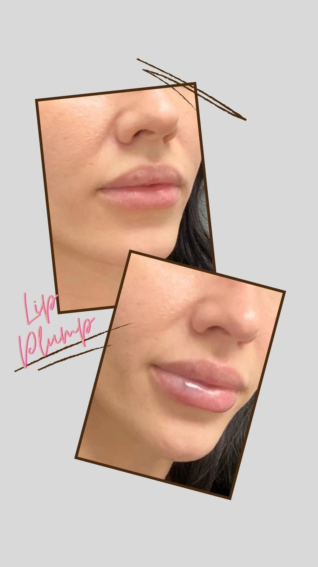 Lip enhancement with filler