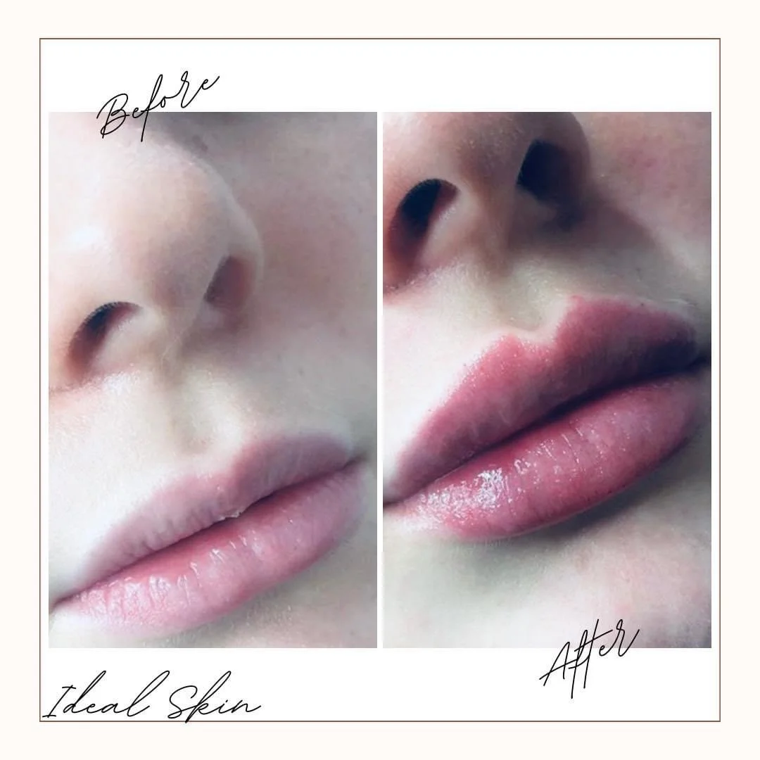 Lip enhancement with filler