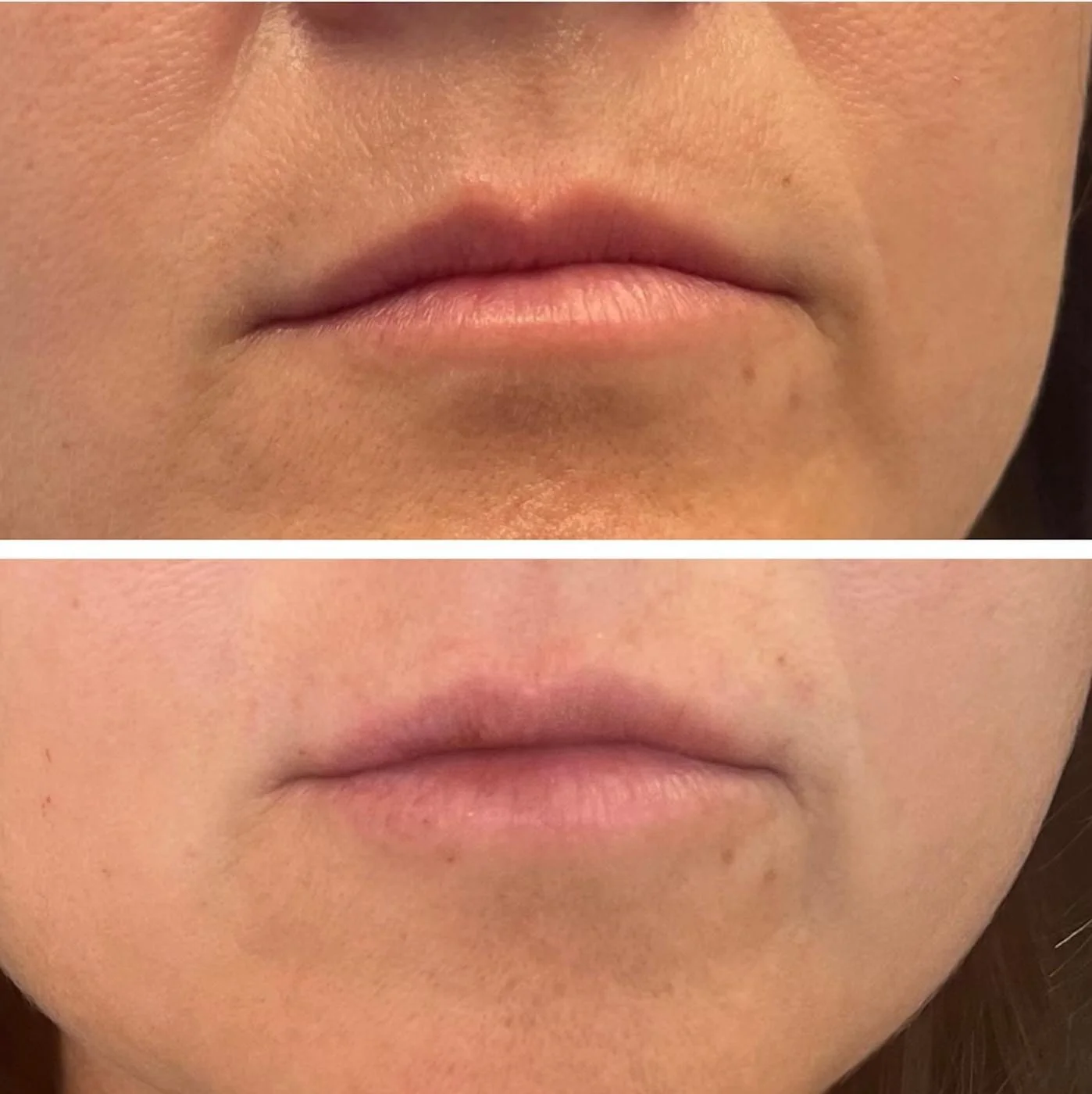 Dermal filler for facial/chin volume restoration