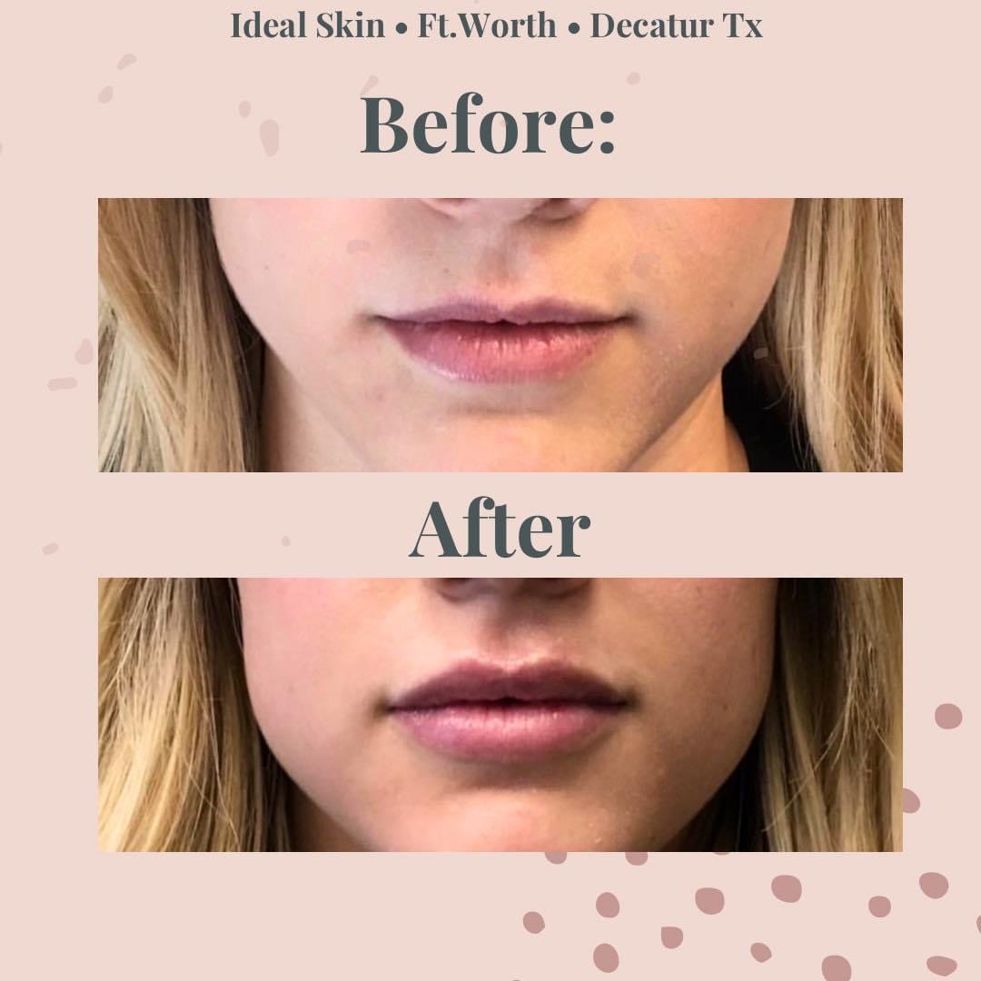 Lip enhancement with filler