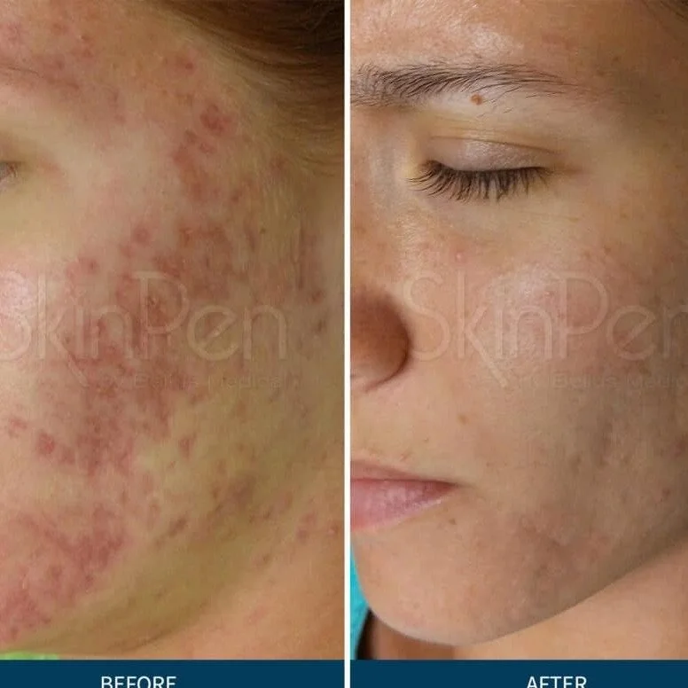 Say hello to smoother, rejuvenated skin! 💉 Purchase 3 SkinPen Microneedling sessions and enjoy a $100 instant rebate. Improve texture, tone, and wrinkles effortlessly. 
✨ Limited availability&mdash;book now! ✨ 
#Microneedling #SkinPen #YouthfulSkin 