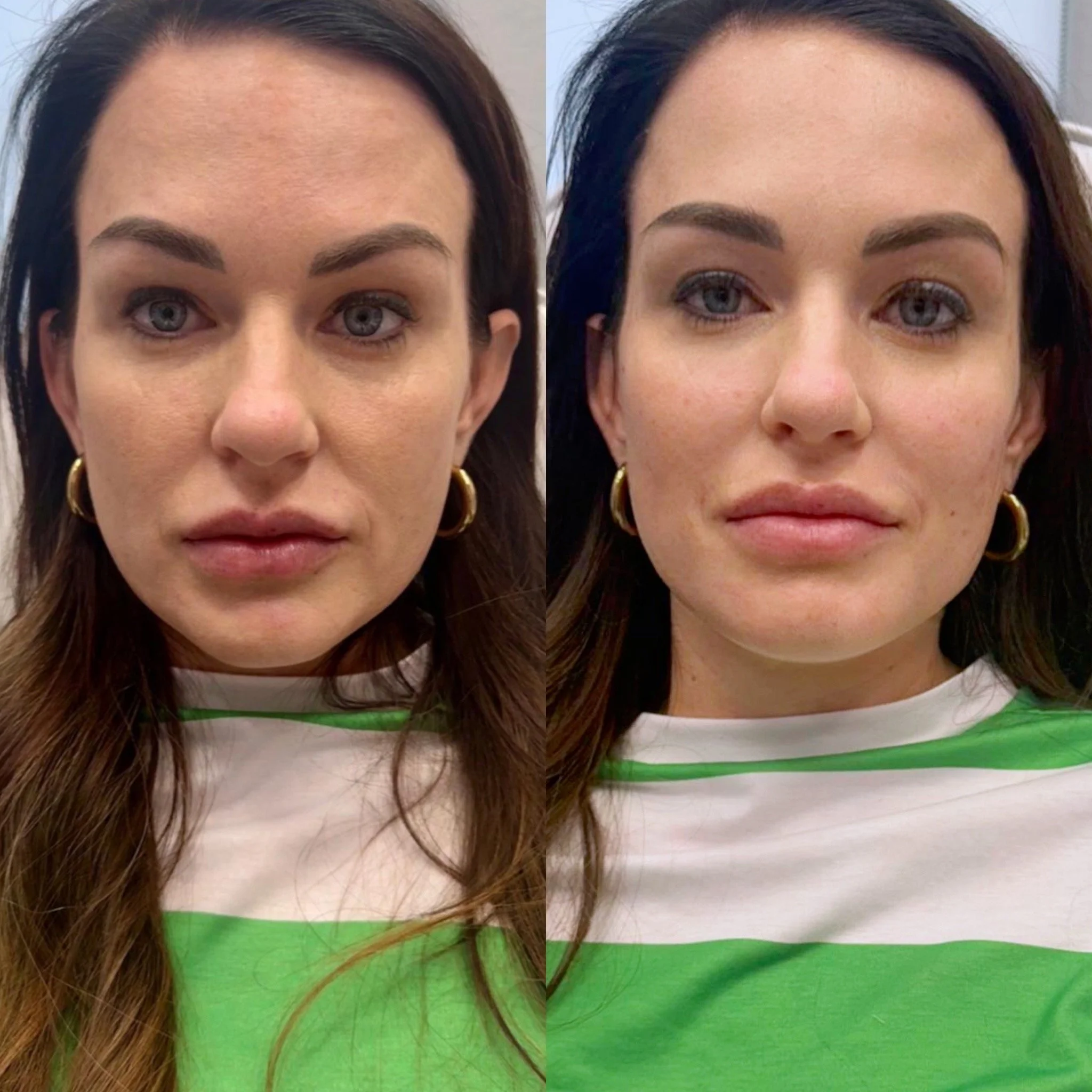 💉✨ Redefine your glow ✨💉 
Looking for an anti-aging solution that delivers stunning, natural results without resorting to surgery? Our August special on dermal fillers (Buy one get 2nd 50% off!) offers a personalized approach to restoring volume an