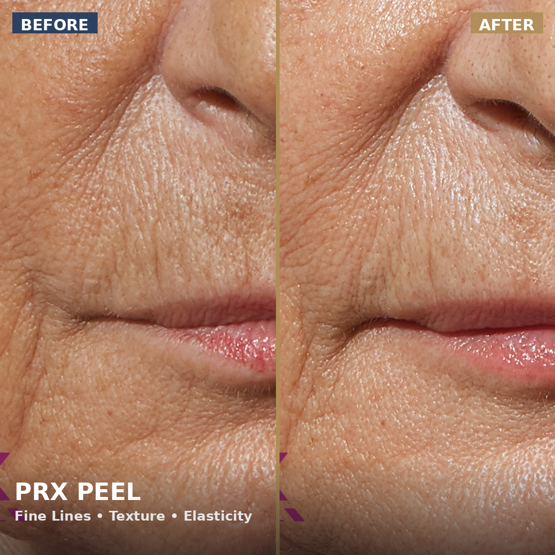 What Is a PRX Peel? Benefits, Downtime, and What to Expect