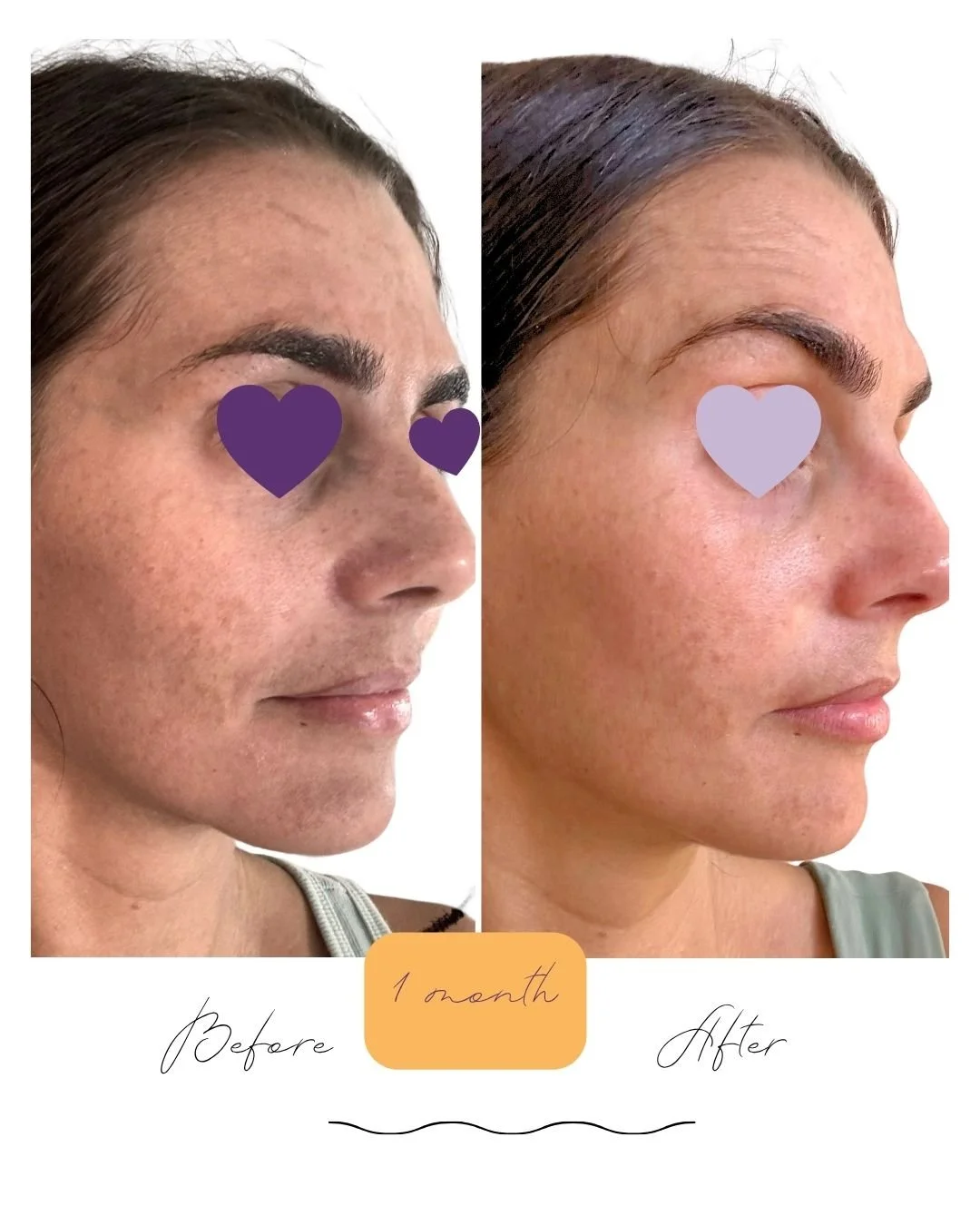 Natasha 1 mo Right before after.jpg