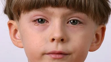 Conjonctivite Pédiatrique : Comprendre, Prévenir et Traiter