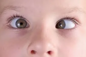 Le strabisme chez l’enfant : comprendre, détecter et traiter