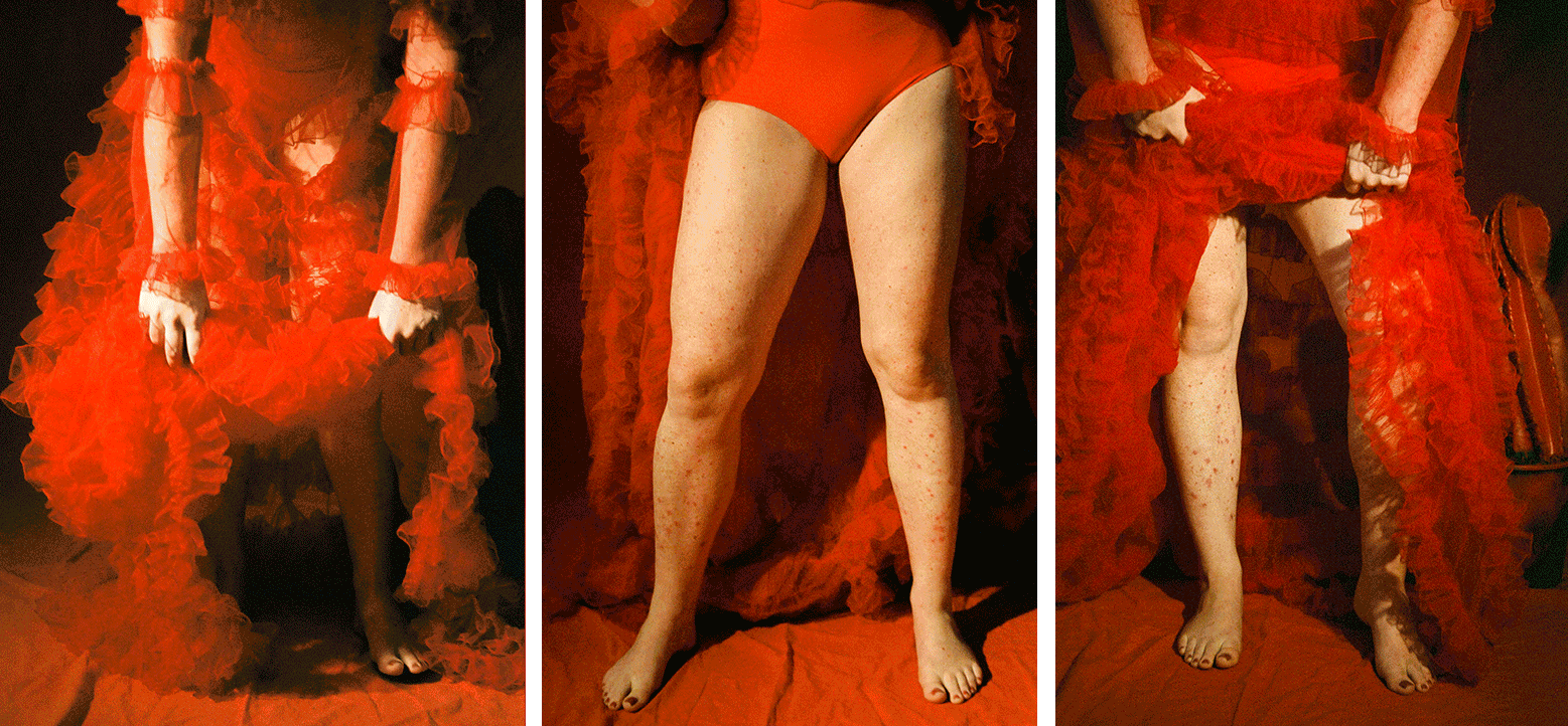 psoriasis-photoshoot (1).gif