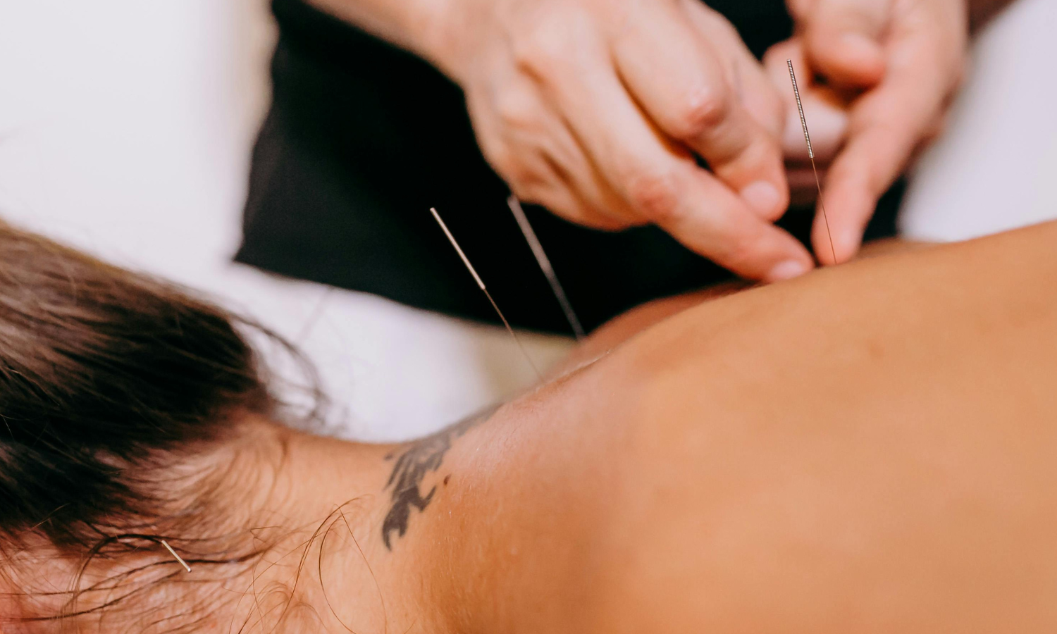 Acupuncture &amp; Your Fertility Journey