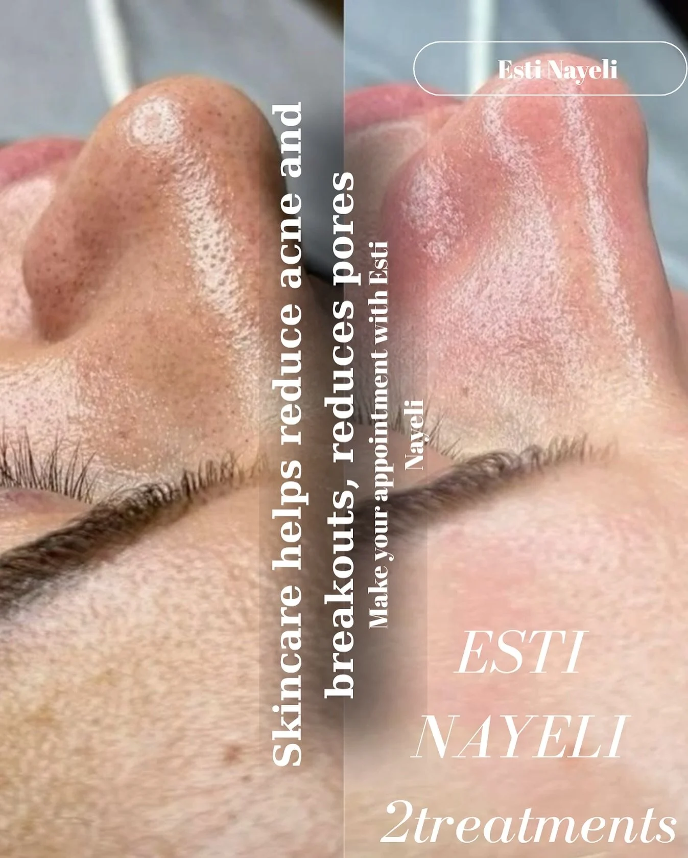 🌸 Skin Transformation Spotlight 🌸
BOOK WITH ME YOUR ESTI NAYELI 
vagaro.com/vividbeautyclinic
call - 720-461-1602
Look at this gorgeous before & after! ✨ After just two facial treatments using our Signature Deep Cleansing Facial, our client&r