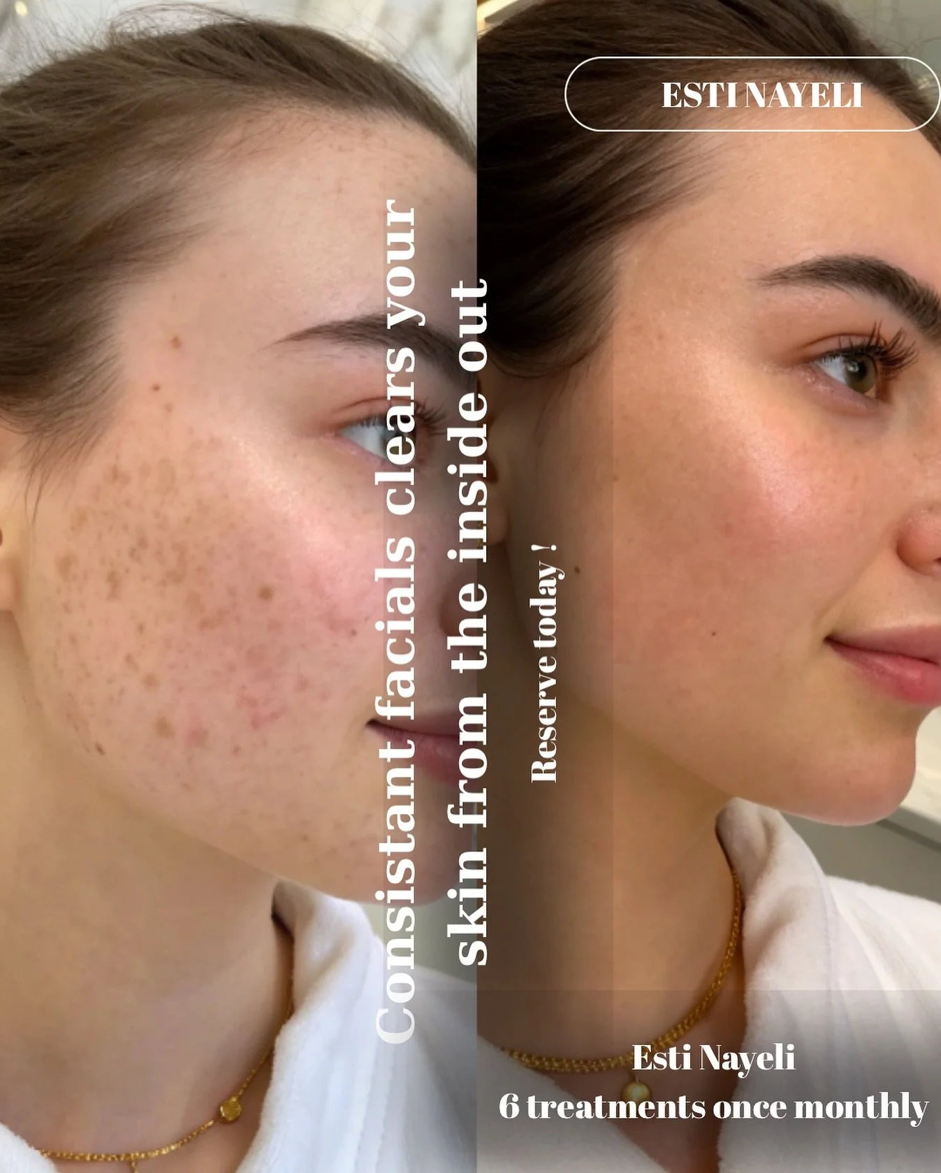 ✨ Consistency = Results ✨
BOOK WITH ME YOUR ESTI NAYELI
vagaro.com/vividbeautyclinic
720-461-1602
Our beautiful client has completed 6 skin treatments — and just look at that glow! 🌸
We started her journey with our Skin Lux Trio Facial, fol