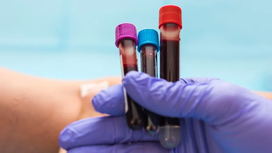 Iron Deficiency and Fatigue: Why Your Blood Test May Be Missing the Full Picture