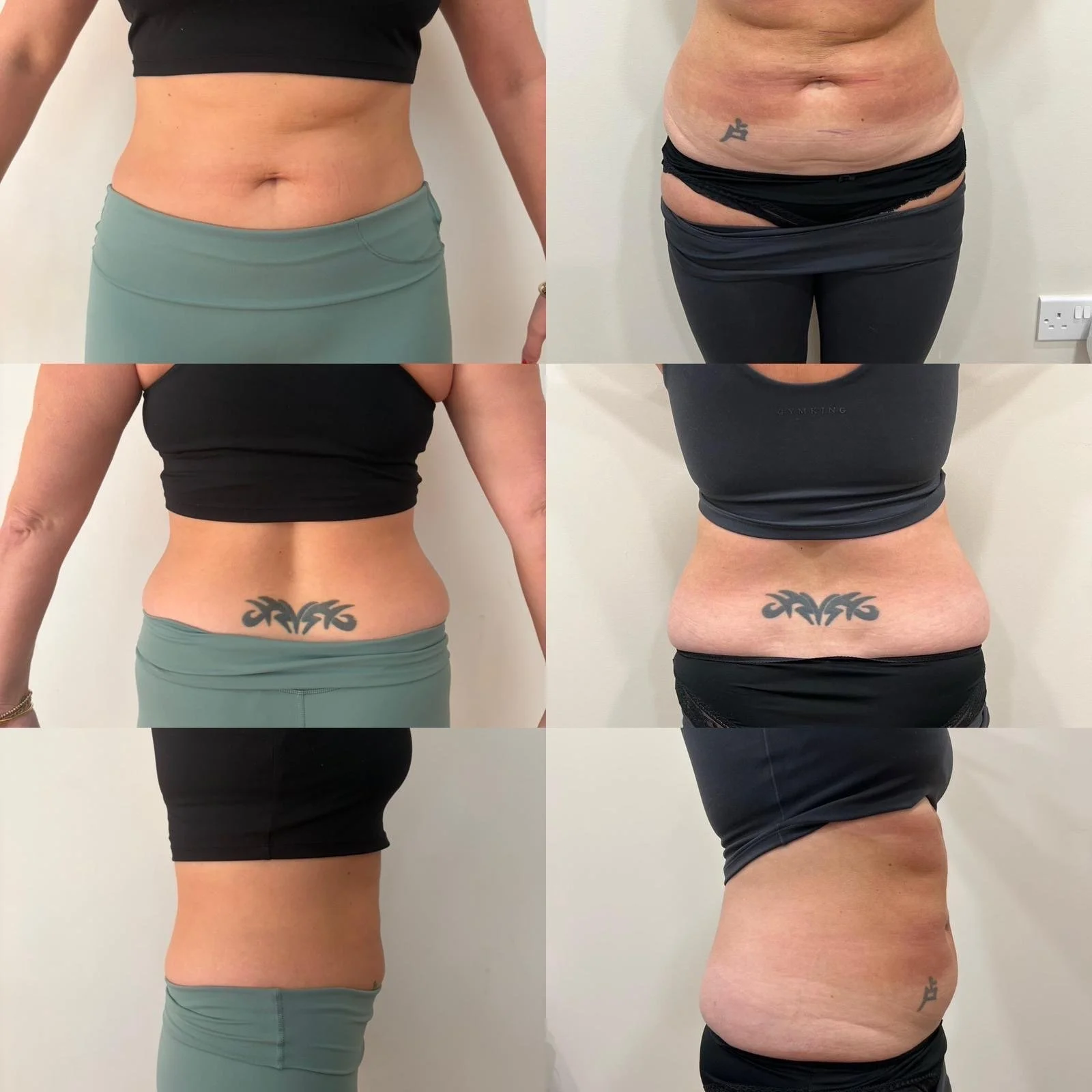 x6 sessions of body contouring_.jpg