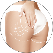Close-up of a woman's lower back and upper buttocks with surgical markings for a cosmetic procedure.