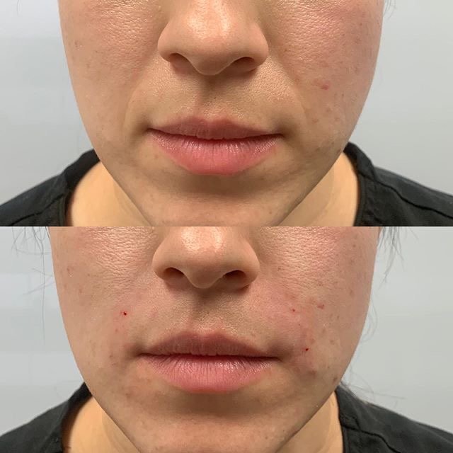 Dermal filler before and after Nasolabial Folds in Plano TX
