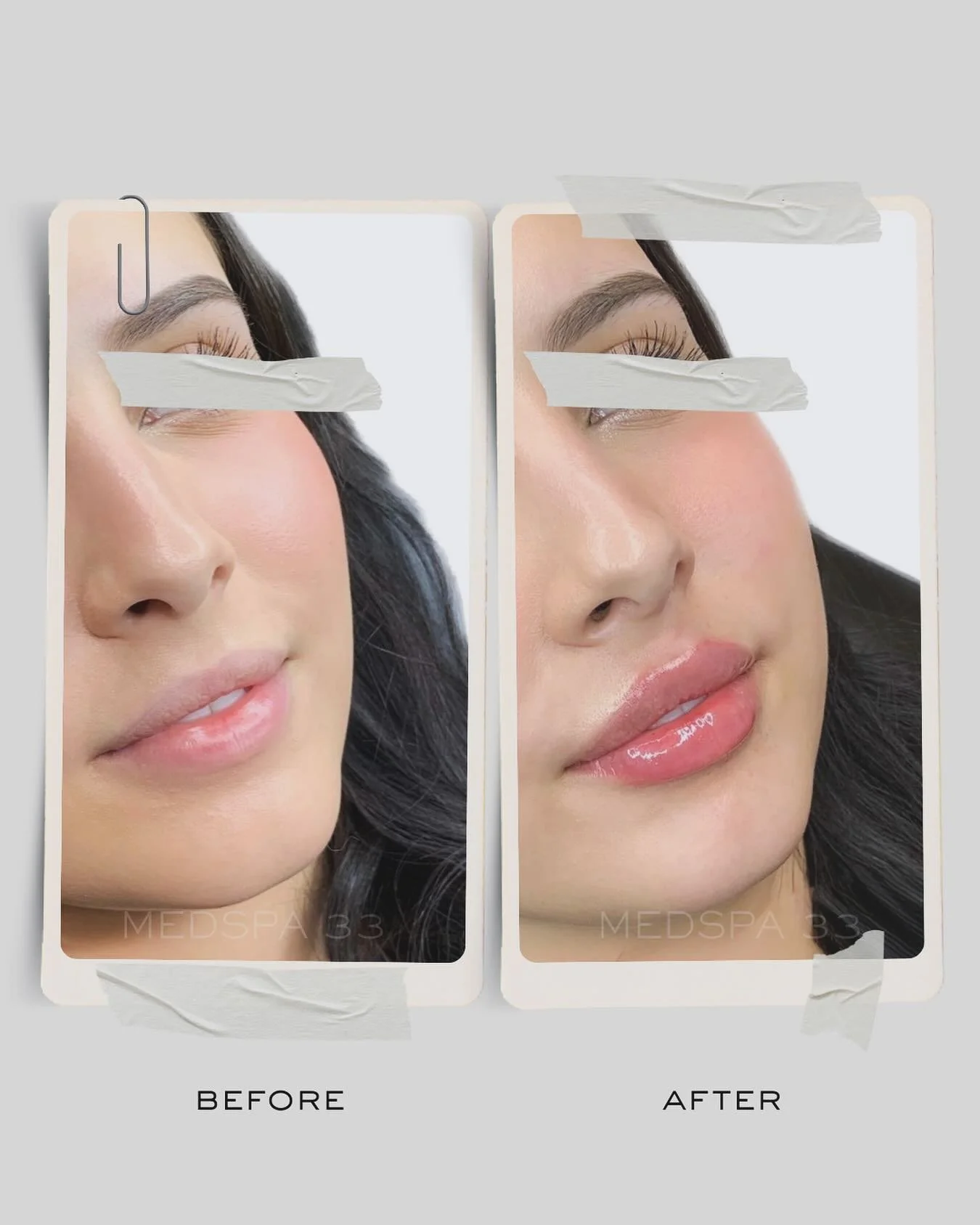Lip Filler🪄
.
.
▫️Treatment: Lip filler
▫️Results: Immediate
▫️Technique: Needle
▫️Time: 30 mins
▫️Pain level: Minimal with numbing
▫️Downtime: None
.
.
🪄MEDSPA33.COM