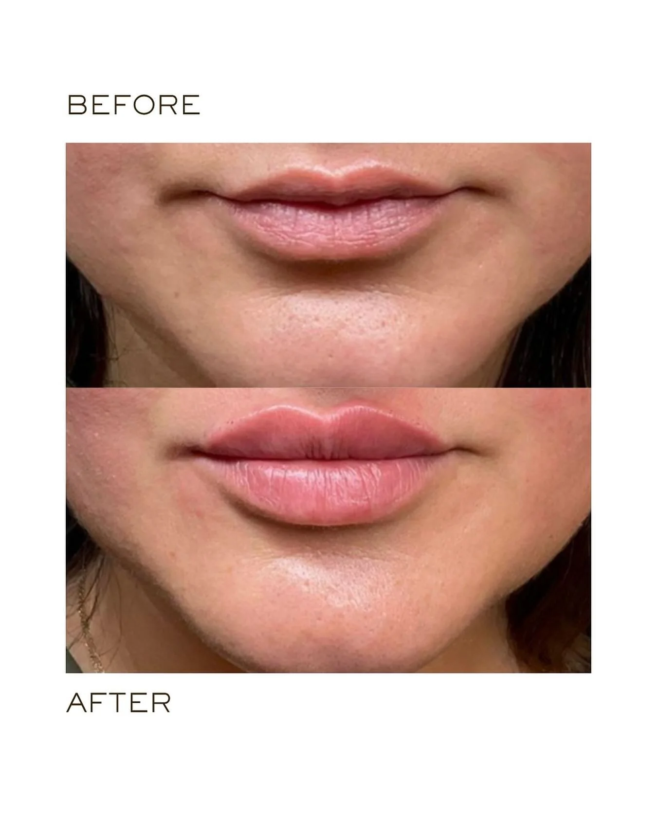 Lip Filler🪄
.
.
▫️Treatment: Lip Filler
▫️Results: Immediate
▫️Results last: up to 12 months
▫️Technique: needle
▫️Time: 30 mins 
▫️Pain level: Minimal to none, with topical numbing added for comfort. 
.
.
🪄MEDSPA33.COM
📱469-953-3812