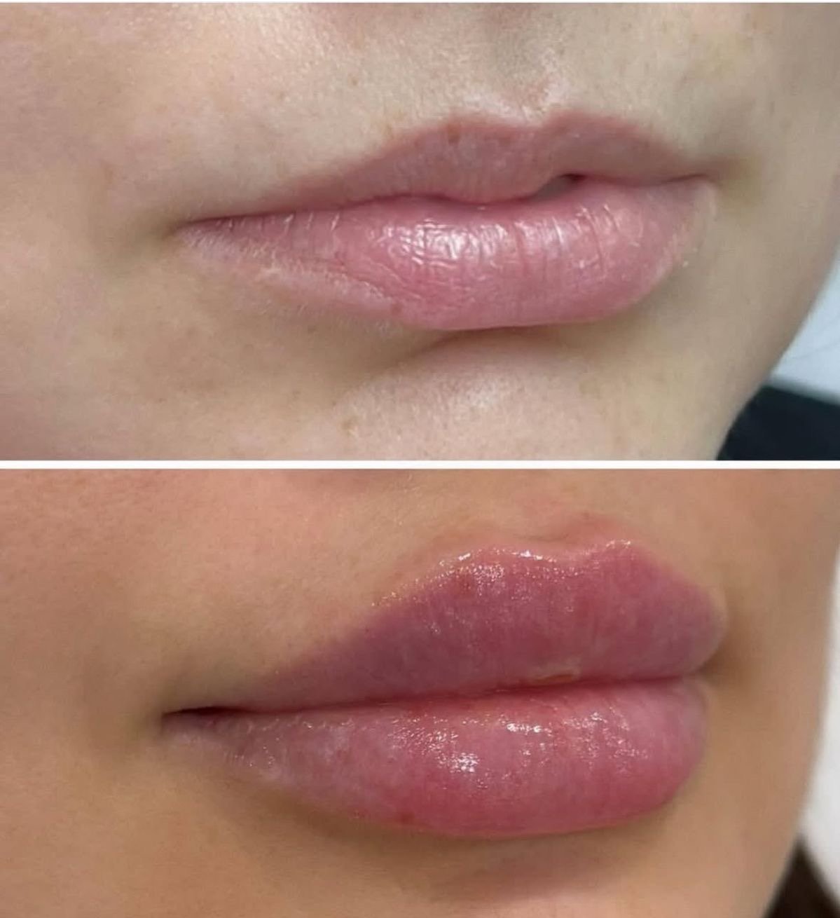 Lip Filler before and after Plano TX