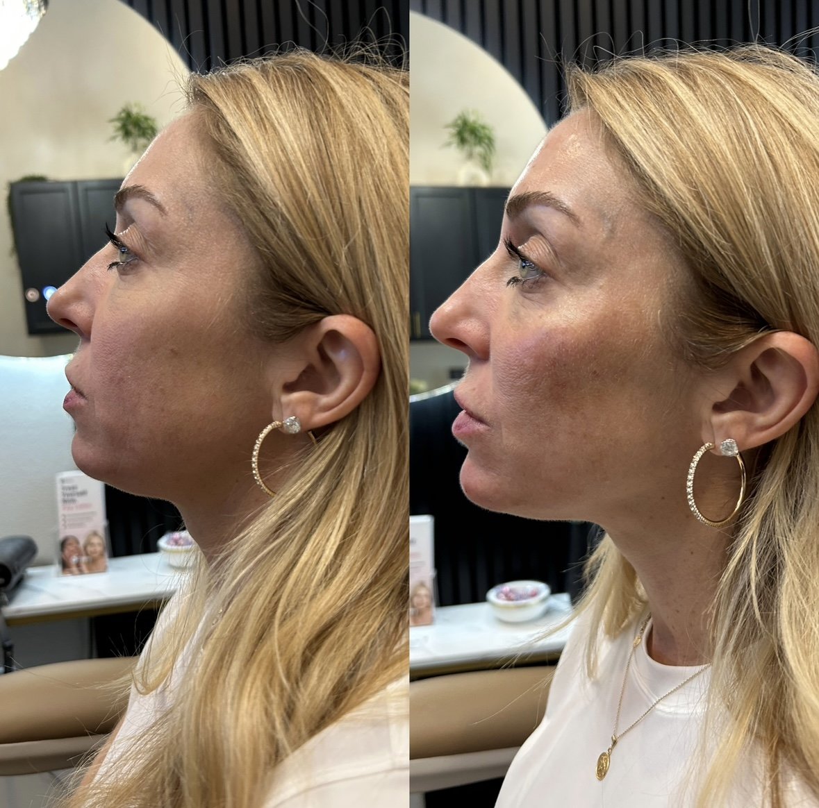 Chin Filler before and after Plano TX