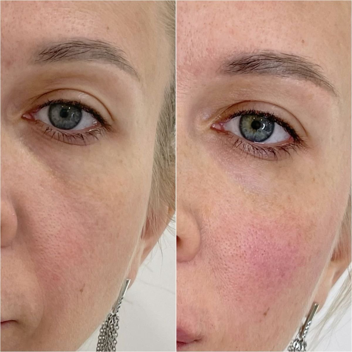 Dermal filler before and after Plano TX