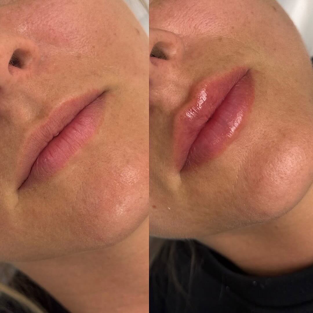 Lip Filler before and after Plano TX