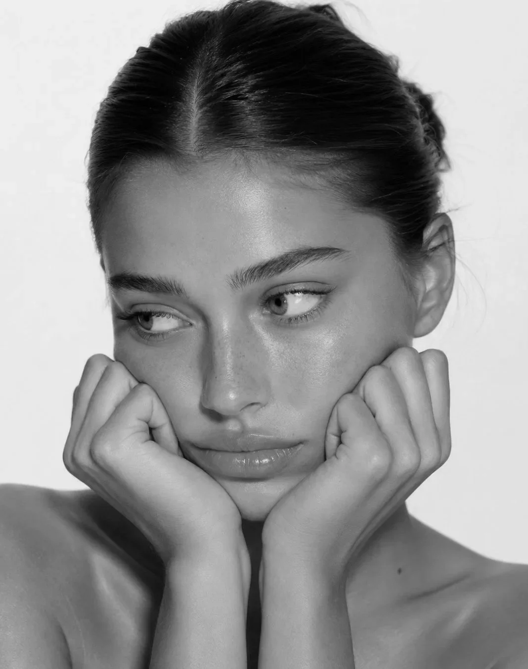 Botox for Chronic Migraines