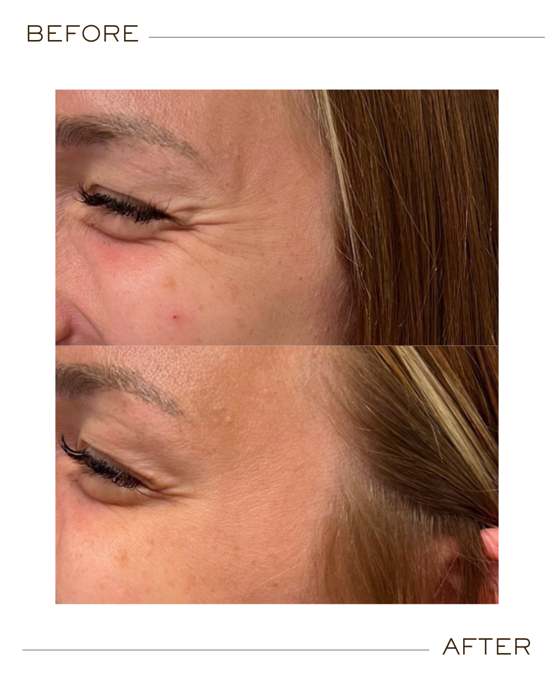 Botox before and after Plano TX
