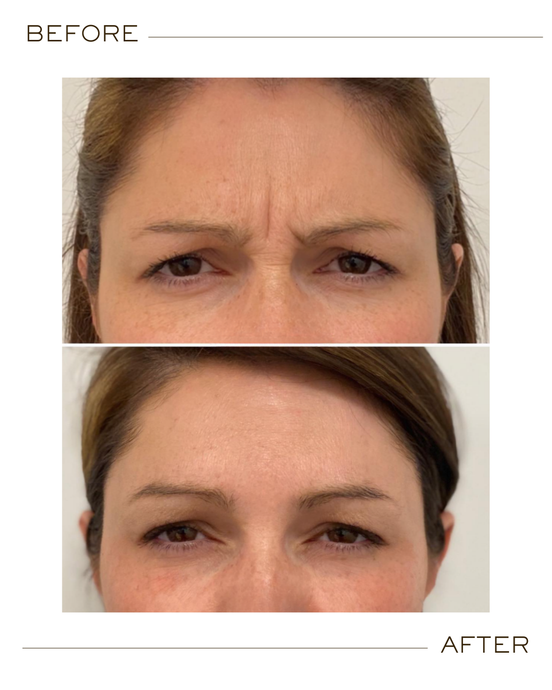 Botox before and after Plano TX