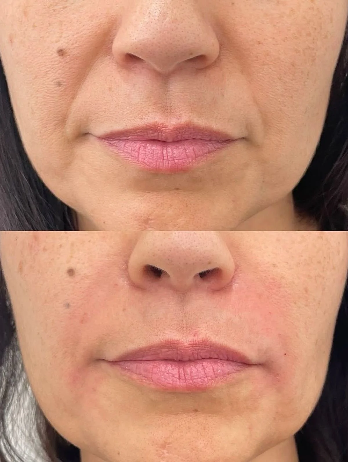 Dermal filler before and after nasolabial folds filler Plano TX
