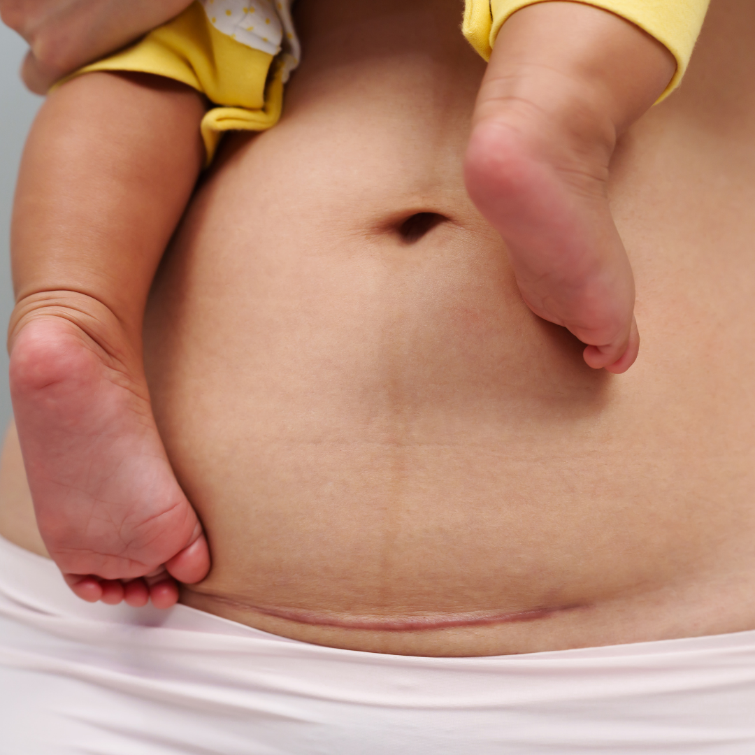 Close-up of a baby's naked belly with an adult's hand gently supporting, with a yellow sleeve partially visible.