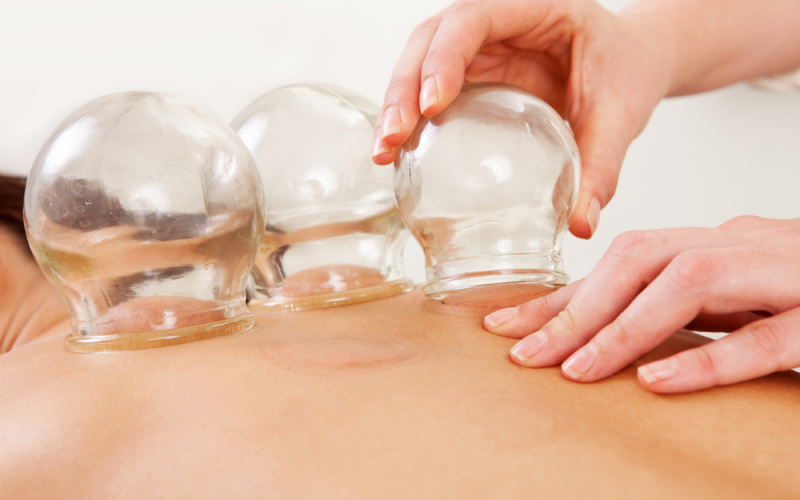 Cupping Remedial Massage Bribie Island. Massage Bribie Island.