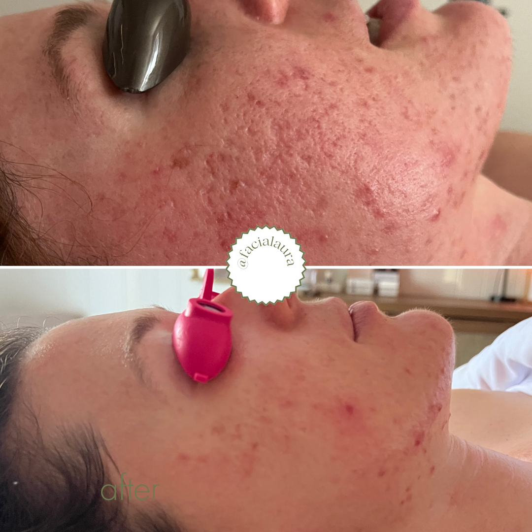 Close-up side view of a person's face with visible redness and acne.  The top photos is a before photo and the bottom photo is a progress photo of acne scarring healing.