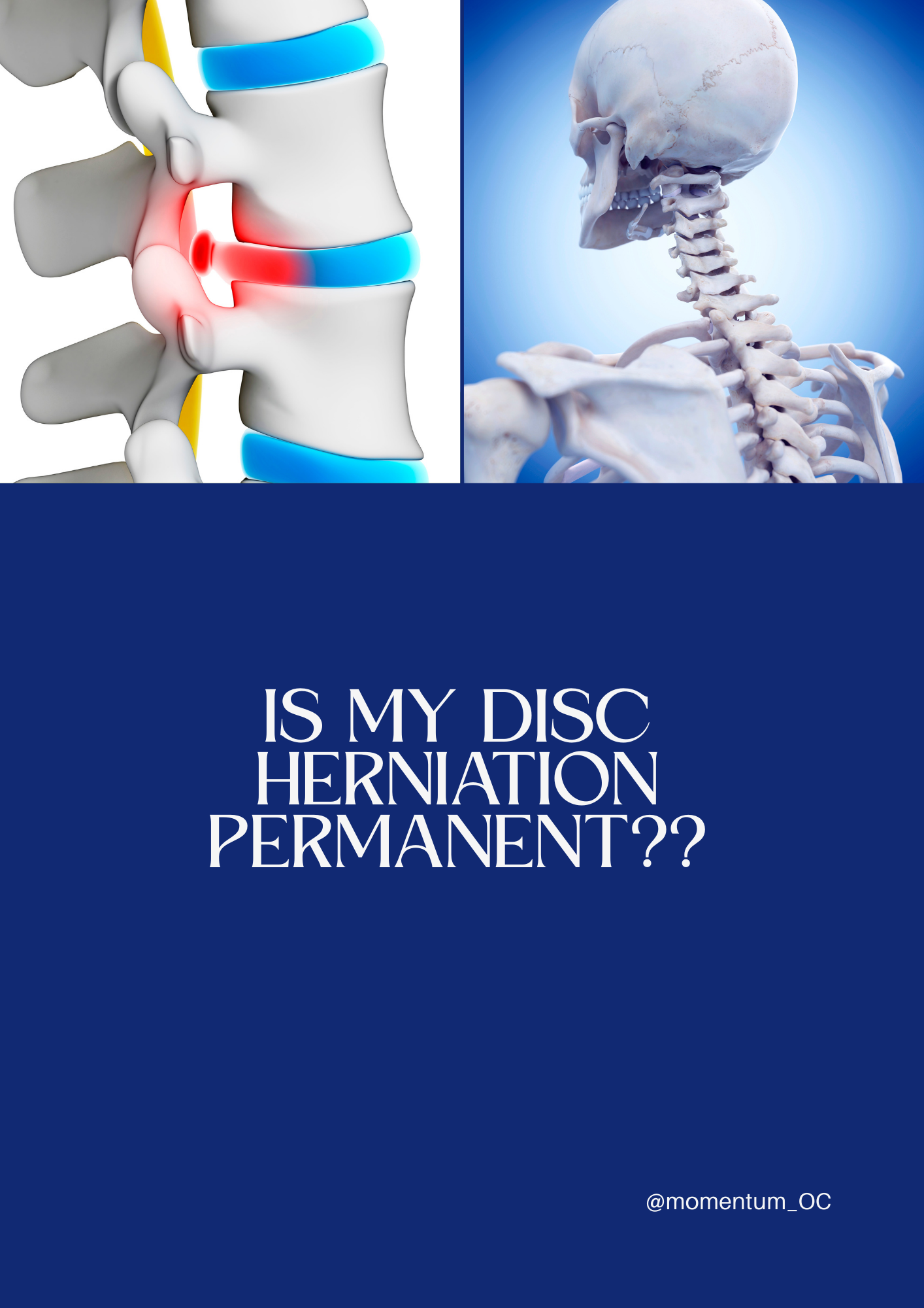 Do Disc Herniations Heal?