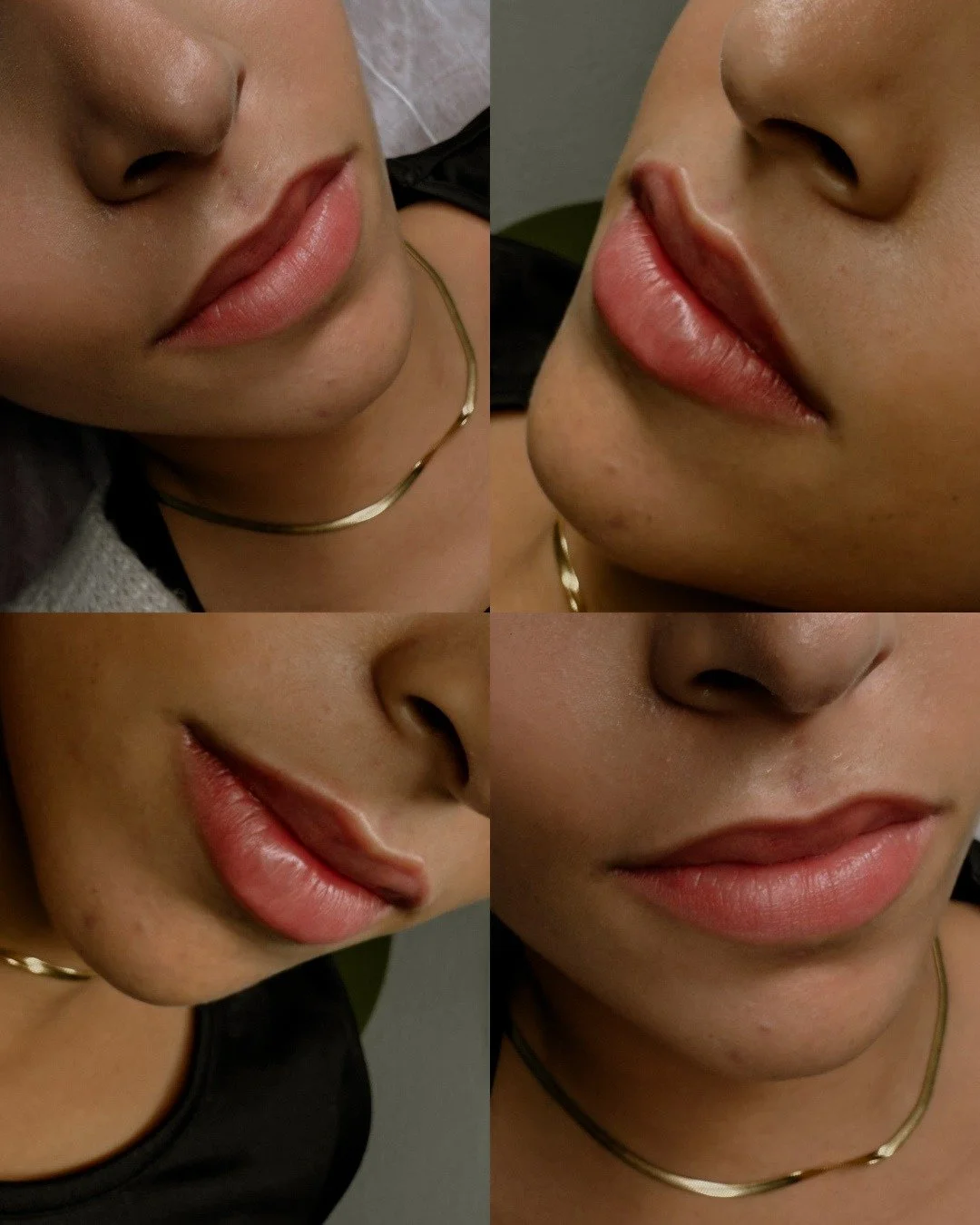 Russian Lips – für elegante Lippen mit natürlicher Kontur 💉
Flach, definiert und harmonisch: Die Russian-Technik zaubert Dir ein Lippenherz zum Verlieben – ganz ohne „Schlauchboot“-Effekt.
Jetzt Termin sichern &