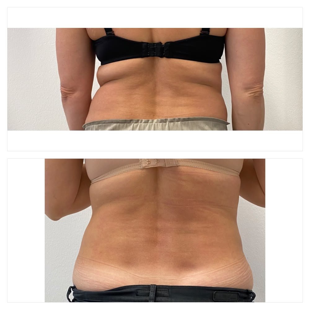 Vergleich von Rückenbildern: Oben sichtbare Hautfalten und Cellulite, unten glattere Haut mit weniger Falten.