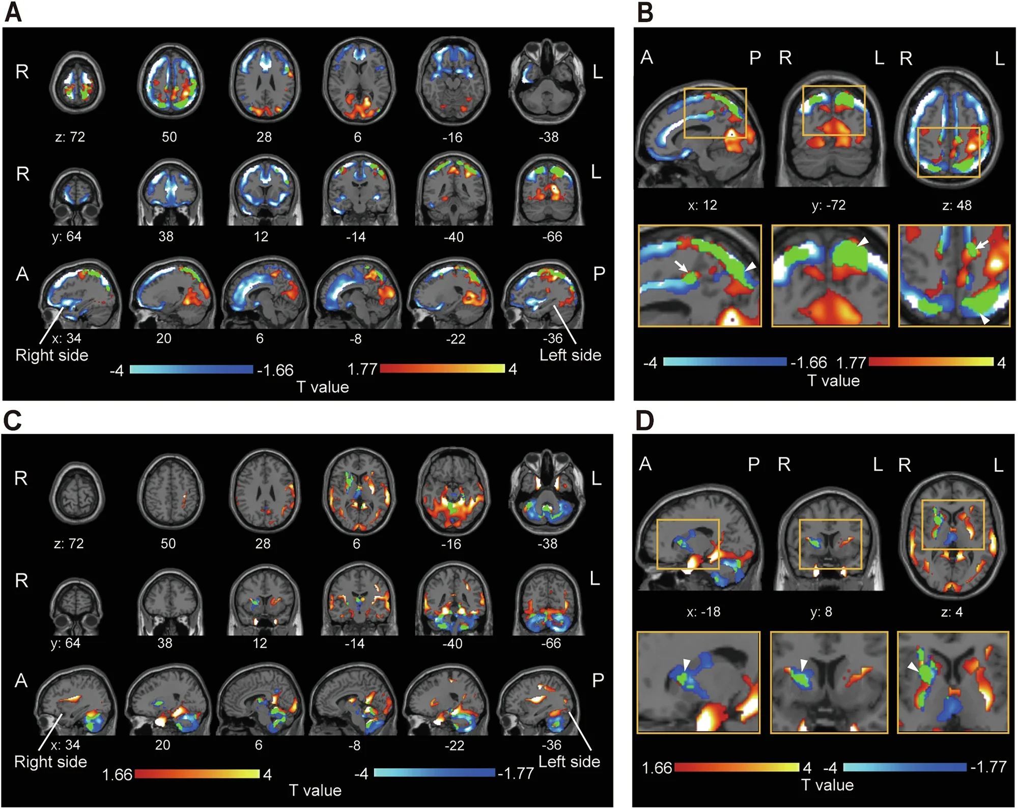 Brain Scans Show How Ketamine Lifts Treatment-Resistant Depression
