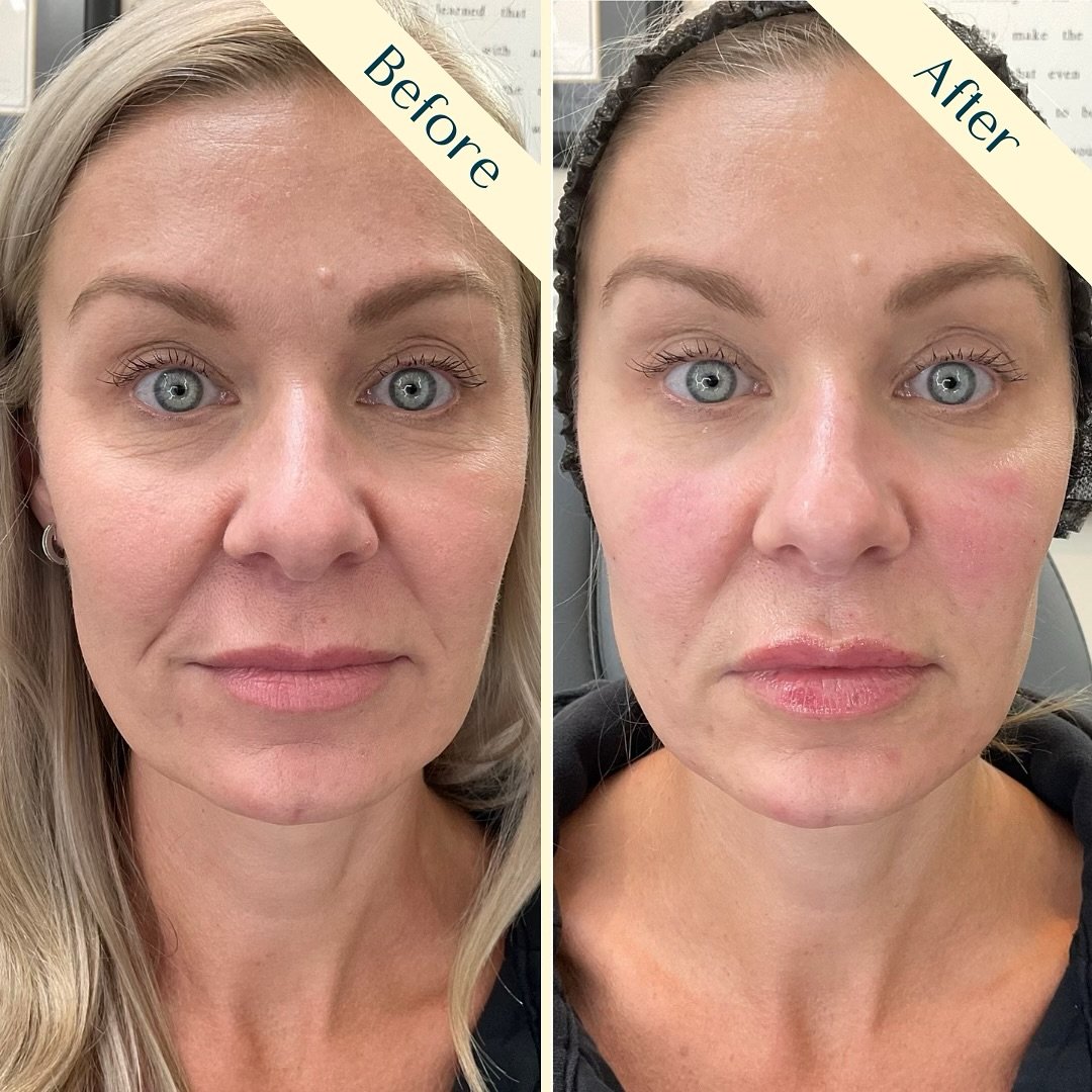 Humble Beauty, Medical Aesthetics, Kitsap, Kingston, Safe, FDA approved, botox, filler, Poulsbo, Silverdale, Bremerton, Washington, consultation, dissolve, near me, best, microneedling, tear trough, peel, Dermal filler, med spa, RN, wrinkle relax

 g