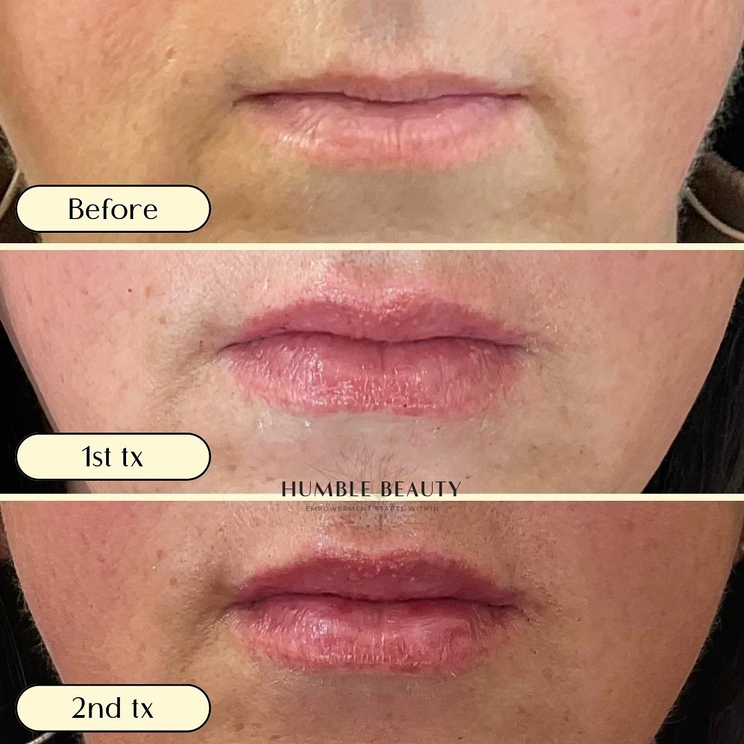 Humble Beauty, Medical Aesthetics, Kitsap, Kingston, Safe, FDA approved, botox, filler, Poulsbo, Silverdale, Bremerton, Washington, consultation, dissolve, near me, best, microneedling, tear trough, peel, Dermal filler, med spa, RN, wrinkle relax

 g