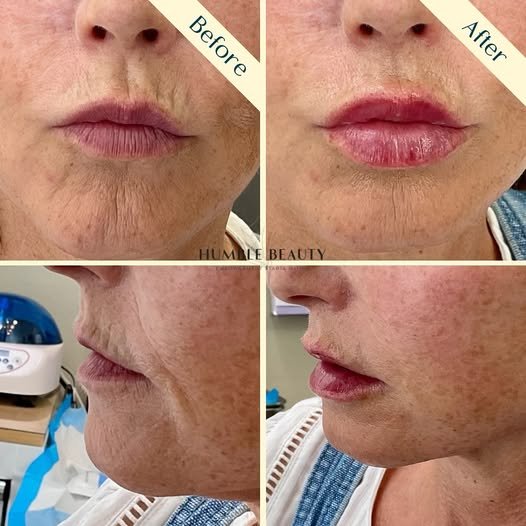 Humble Beauty, Medical Aesthetics, Kitsap, Kingston, Safe, FDA approved, botox, filler, Poulsbo, Silverdale, Bremerton, Washington, consultation, dissolve, near me, best, microneedling, tear trough, peel, Dermal filler, med spa, RN, wrinkle relax

 g