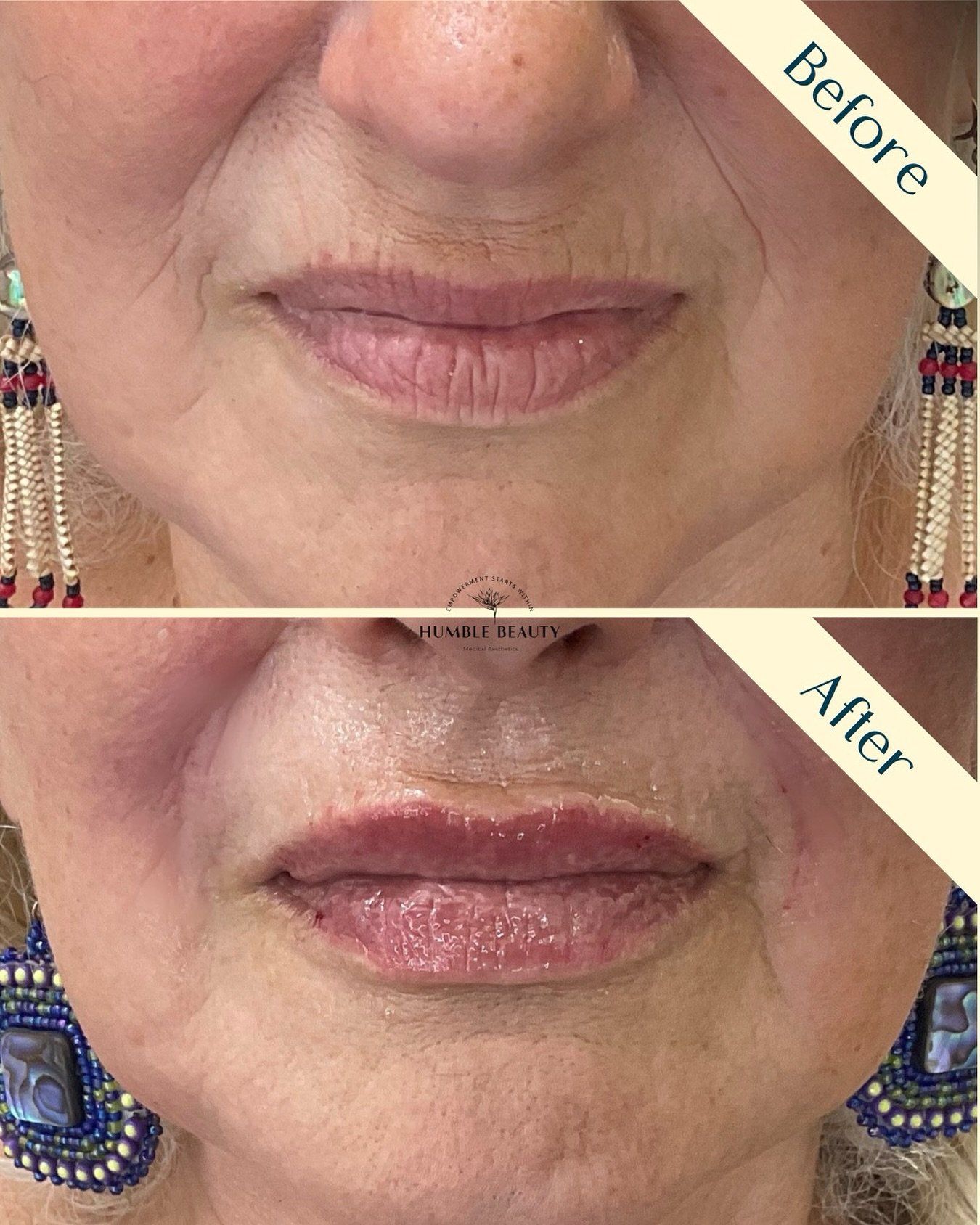 Humble Beauty, Medical Aesthetics, Kitsap, Kingston, Safe, FDA approved, botox, filler, Poulsbo, Silverdale, Bremerton, Washington, consultation, dissolve, near me, best, microneedling, tear trough, peel, Dermal filler, med spa, RN, wrinkle relax

 g