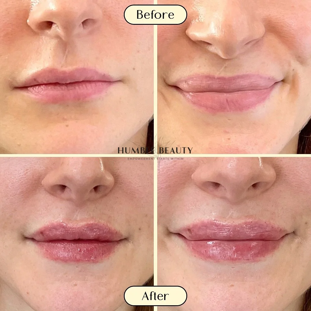 Humble Beauty, Medical Aesthetics, Kitsap, Kingston, Safe, FDA approved, botox, filler, Poulsbo, Silverdale, Bremerton, Washington, consultation, dissolve, near me, best, microneedling, tear trough, peel, Dermal filler, med spa, RN, wrinkle relax

 g