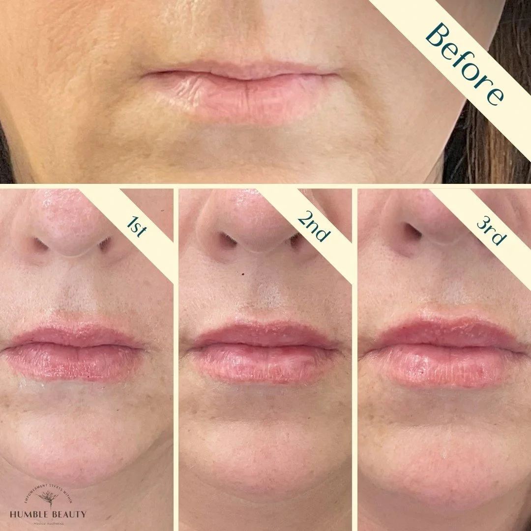 Humble Beauty, Medical Aesthetics, Kitsap, Kingston, Safe, FDA approved, botox, filler, Poulsbo, Silverdale, Bremerton, Washington, consultation, dissolve, near me, best, microneedling, tear trough, peel, Dermal filler, med spa, RN,
gallery, neurom