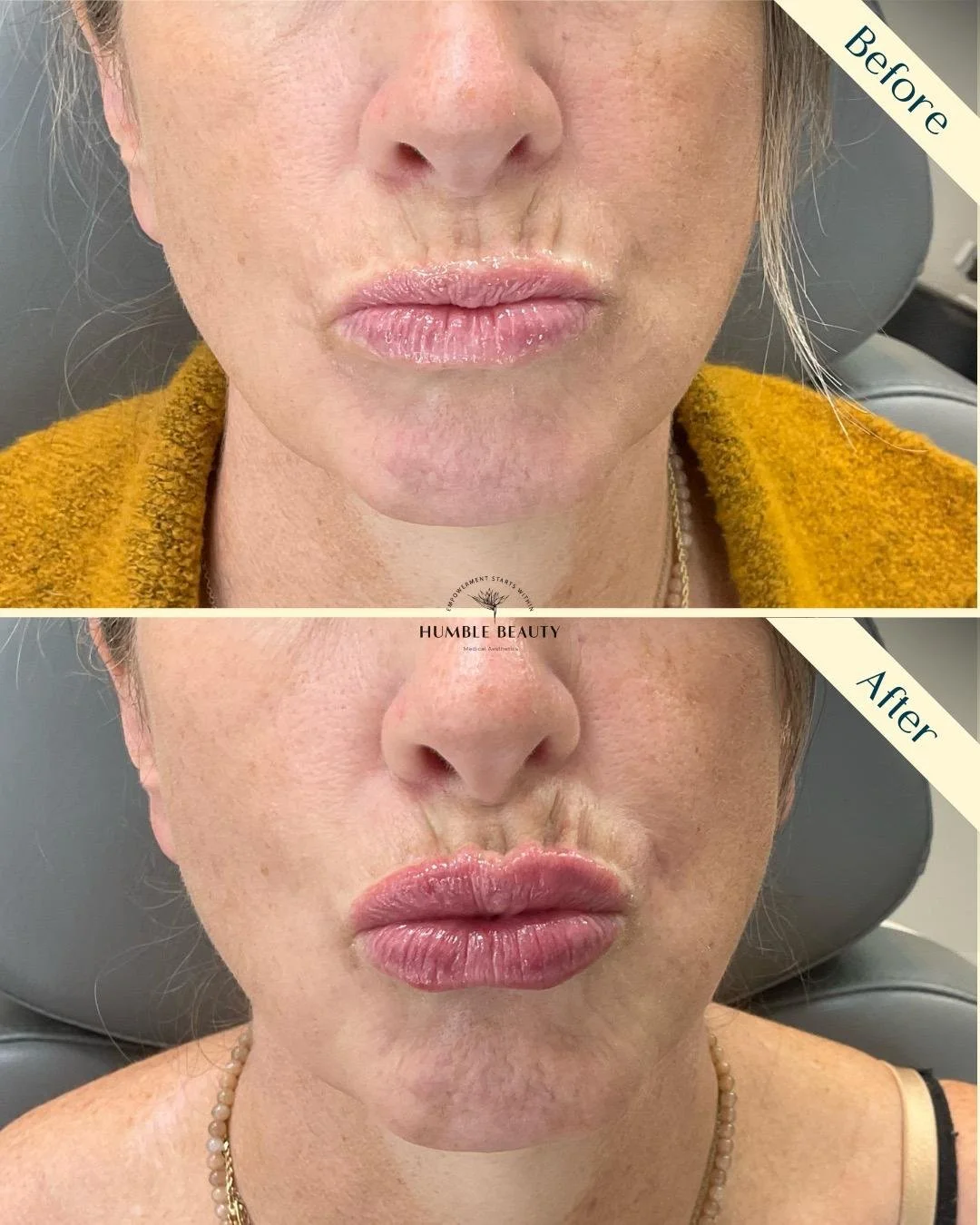 Humble Beauty, Medical Aesthetics, Kitsap, Kingston, Safe, FDA approved, botox, filler, Poulsbo, Silverdale, Bremerton, Washington, consultation, dissolve, near me, best, microneedling, tear trough, peel, Dermal filler, med spa, RN,
gallery, neurom