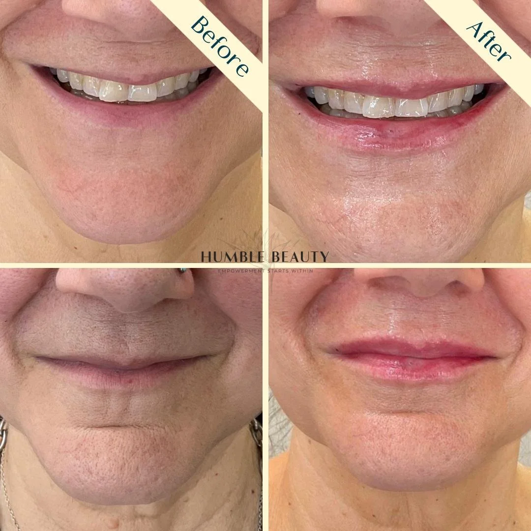 Humble Beauty, Medical Aesthetics, Kitsap, Kingston, Safe, FDA approved, botox, filler, Poulsbo, Silverdale, Bremerton, Washington, consultation, dissolve, near me, best, microneedling, tear trough, peel, Dermal filler, med spa, RN,
gallery, neurom